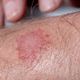 Image for article titled Report: Rash Not Going Away On Its Own